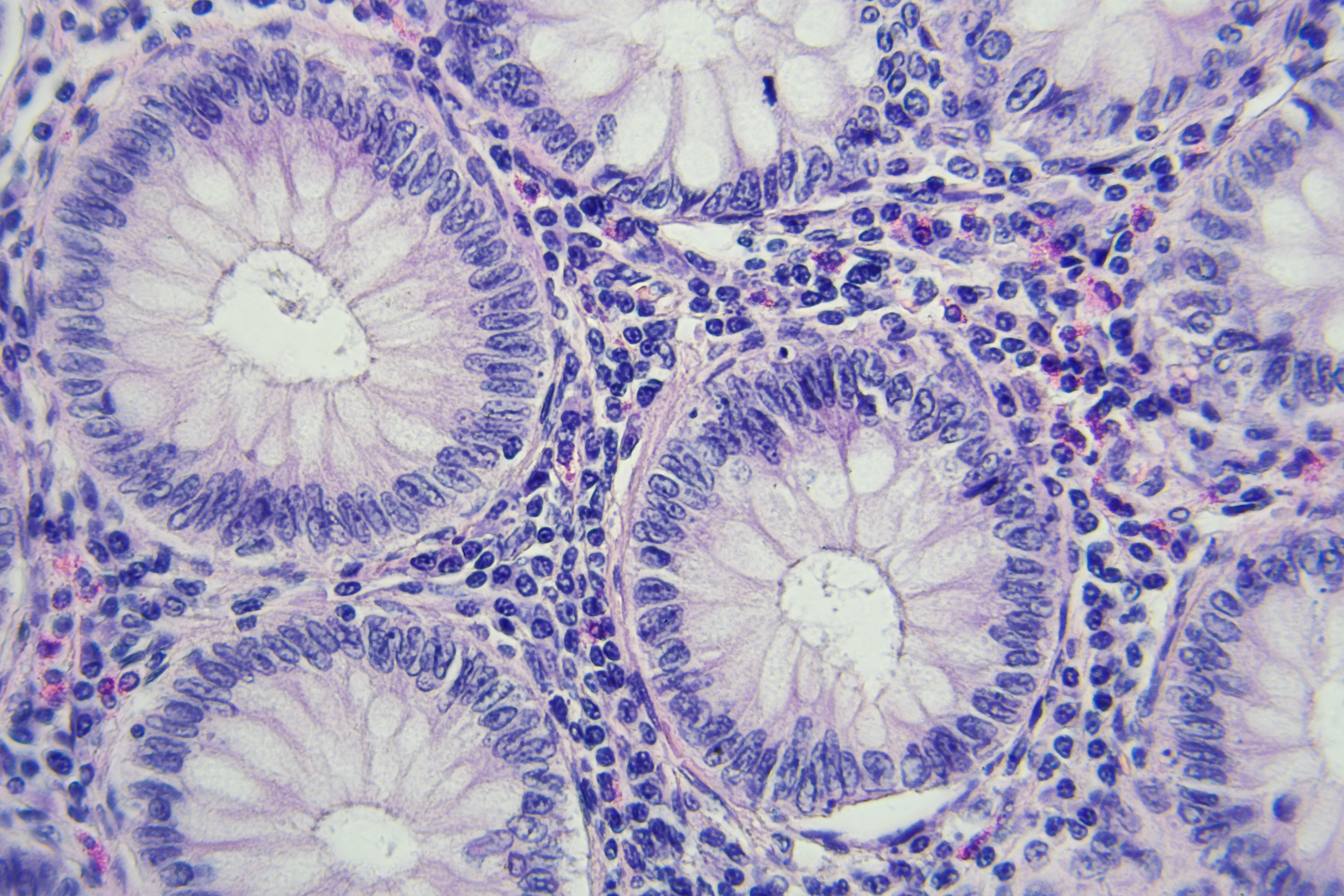 Immunohistochemistry in Precision Medicine: From Biomarker